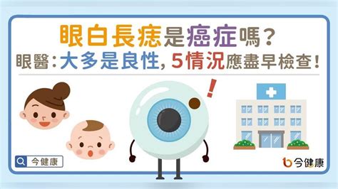 眼睛痣|眼白長痣是癌症嗎？眼醫：大多是良性，5情況應盡早。